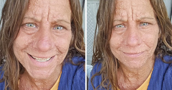 A coragem dessa mulher impressiona ao enfrentar julgamentos por marcas na pele provocadas por transtorno