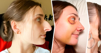 Jovem guarda dinheiro por 12 anos para rinoplastia, e o resultado foi espantoso