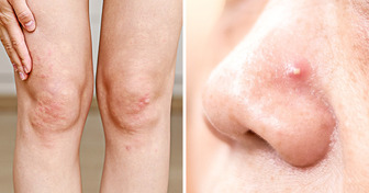 O que a acne em 8 partes do corpo pode revelar sobre seus hábitos