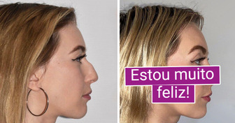 19 Histórias de quem fez cirurgia plástica e decidiu investir na melhor versão de si