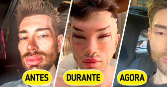 O influenciador “Ken Humano” desfez os preenchimentos e surpreendeu com sua nova versão