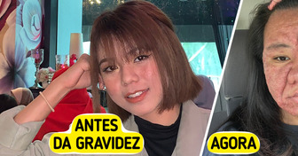 Mulher de 28 anos compartilha transformação chocante do rosto durante a gravidez com total honestidade