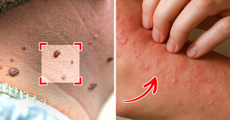 6 Sintomas silenciosos de diabetes que podem passar despercebidos