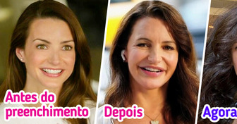 10 Famosas que reverteram procedimentos estéticos e abraçaram sua beleza natural