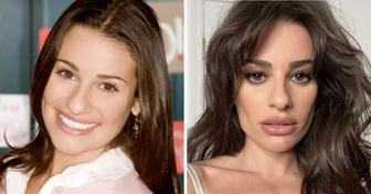 12 Estrelas que mudaram radicalmente depois de fazer uma cirurgia plástica