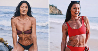 Conheça Sara Geurts, uma modelo de 31 anos com uma condição rara de pele cuja história inspirou muitas pessoas