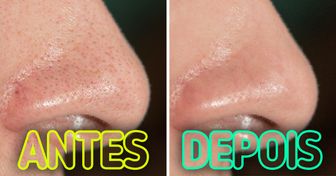 10 Dicas de dermatologistas que podem ajudar a diminuir os poros dilatados