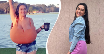 Brasileira bomba nas redes sociais ao compartilhar como venceu a gigantomastia