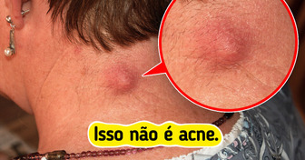 7 Bolinhas que parecem acne, mas podem ser outro problema na sua pele