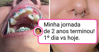 15 Pessoas que transformaram seus sorrisos com tratamentos ortodônticos