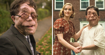 A história de Adam Pearson, que trocou a dor por inspiração para milhões