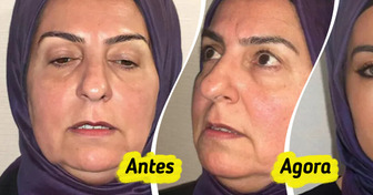 Cirurgia plástica de mulher de 68 anos tem antes e depois que deixou a internet incrédula
