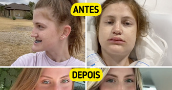 Jovem mostra a transformação após cirurgia na mandíbula e viraliza com o novo visual