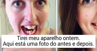 Como o aparelho ortodôntico é capaz de mudar sua aparência (para melhor)