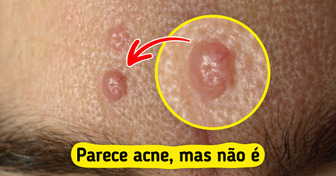 7 Bolinhas na pele que enganam e parecem espinhas comuns