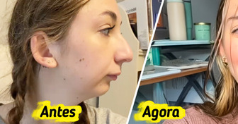 Jovem faz cirurgia na mandíbula e impressiona a internet com o resultado