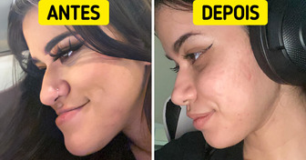16 Pessoas que melhoraram sua imagem com cirurgia plástica