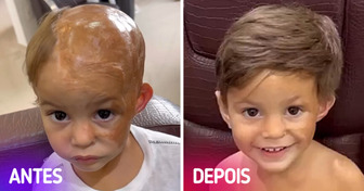 Cabeleireiro paulista dá apliques de cabelo de graça para crianças que perderam seus cabelos por acidentes ou doenças