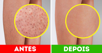 7 Maneiras fáceis de acabar com o “efeito morango” na pele