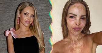 16 Anos após ataque com ácido, Katie Piper comemora uma grande conquista