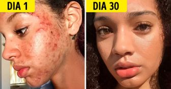 Esta garota curou a acne usando produtos naturais