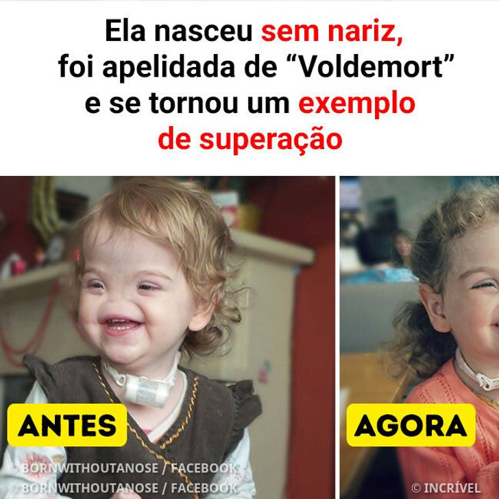 Ela nasceu sem nariz, foi apelidada de “Voldemort” e se tornou um exemplo de superação
