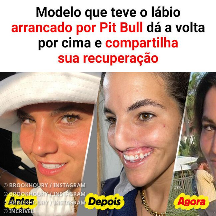 Modelo que teve o lábio arrancado por Pit Bull dá a volta por cima e compartilha sua recuperação