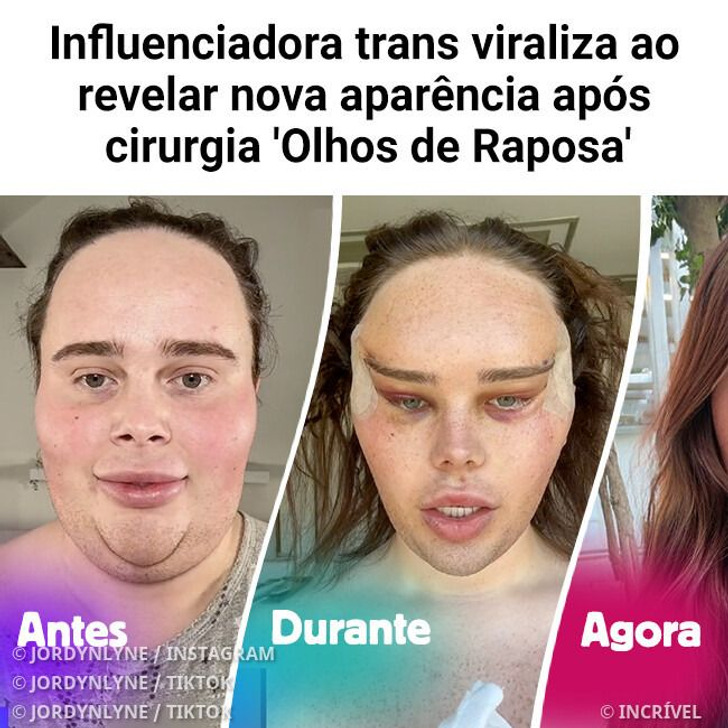 Influenciadora trans viraliza ao revelar nova aparência após cirurgia ‘Olhos de Raposa’