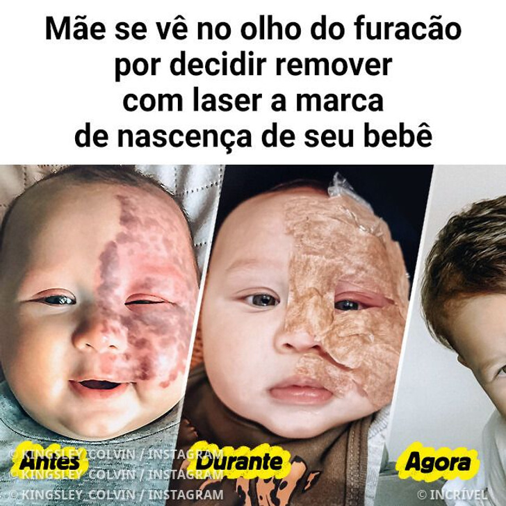 Mãe se vê no olho do furacão por decidir remover com laser a marca de nascença de seu bebê