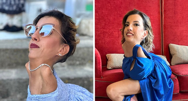 Mesmo com uma condição rara, ela desafiou rótulos e virou inspiração para muita gente