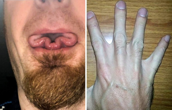 14 Traços raros do corpo humano que certamente fazem seus donos se destacarem