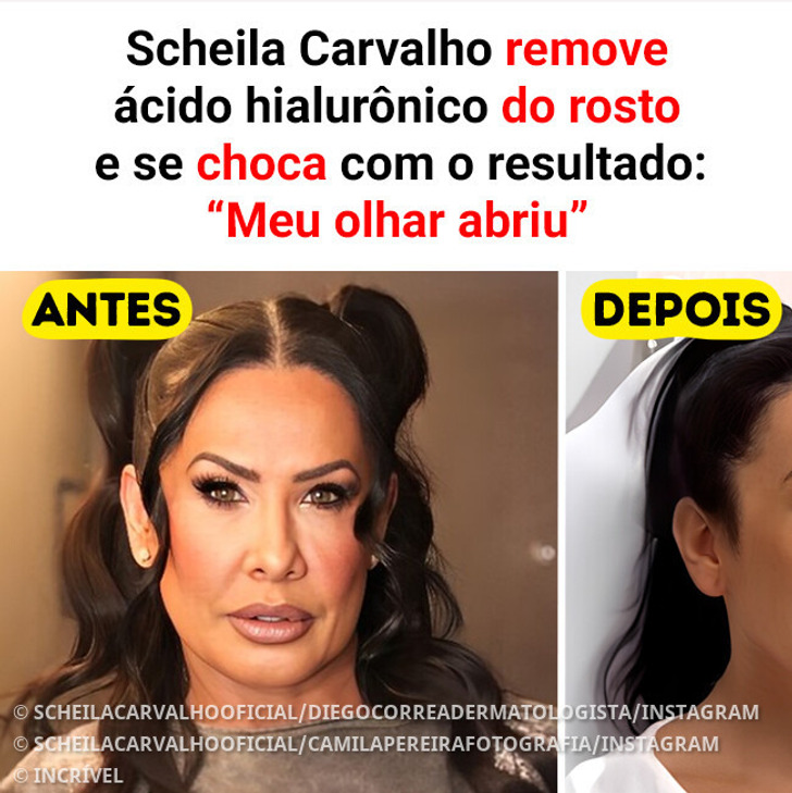 Scheila Carvalho remove ácido hialurônico do rosto e se choca com o resultado: “Meu olhar abriu”