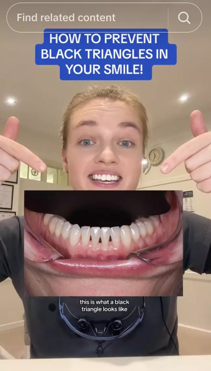 A woman pointing to a photo of teeth with black triangles on them.