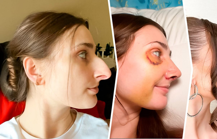Jovem guarda dinheiro por 12 anos para rinoplastia, e o resultado foi espantoso