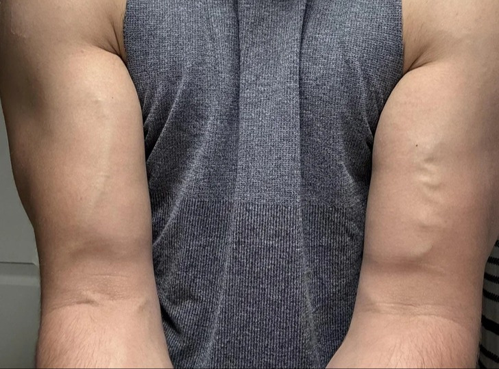 4. "Um dos meus braços tem uma veia reta e o outro tem uma veia irregular"