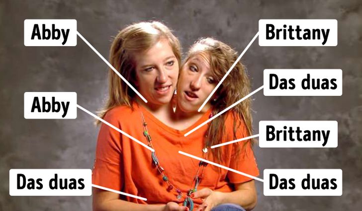 👉Olha que linda história de compartilhamento em só corpo com duas cabeças  femininas😱🧦📢🧐😮🤔👏😍A história de Abby e Brittany Hensel, as famosas  gêmeas conjugadas