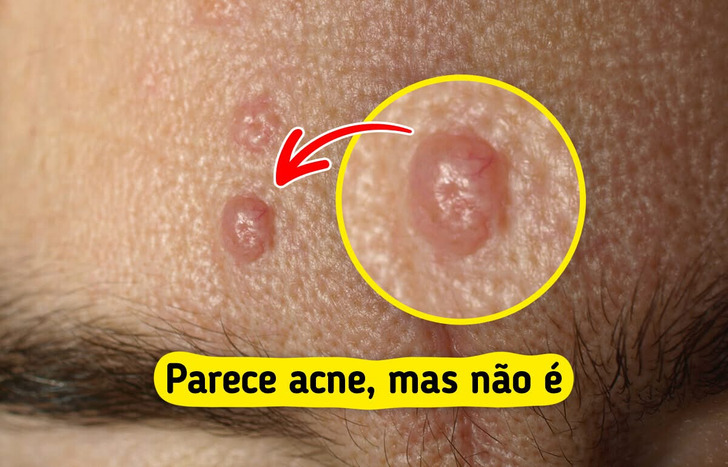 7 Bolinhas na pele que enganam e parecem espinhas comuns