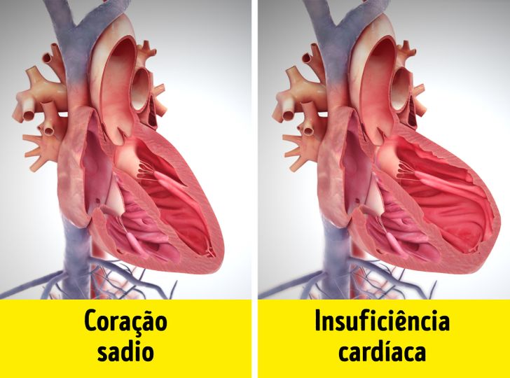 Quem tem insuficiência cardíaca pode se aposentar e como fazer