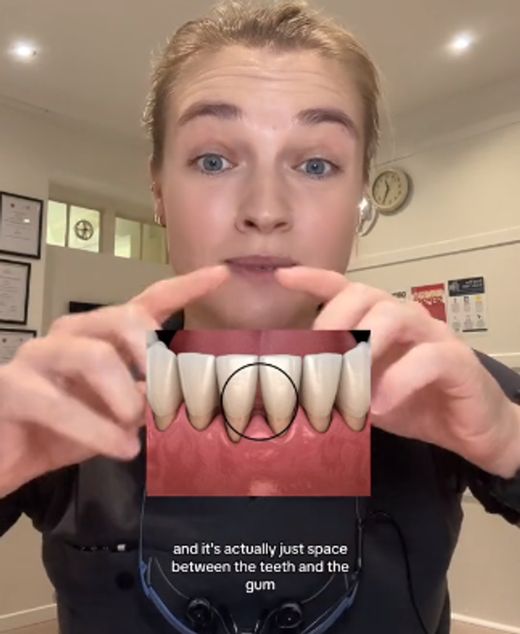 A woman pointing to her teeth and a zoomed photo of teeth with spaces.